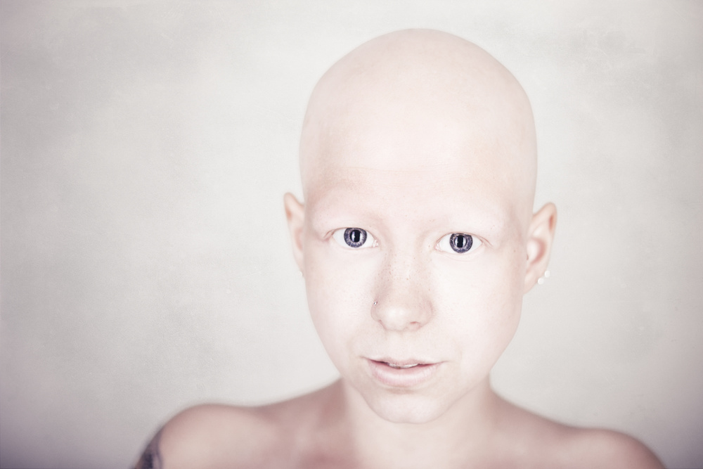 Alopecia universalis de Kimmo Lundahl